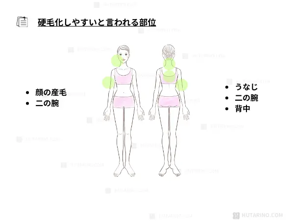 硬毛化しやすい場所を説明するイラスト