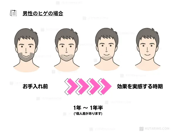家庭用レーザー脱毛器 tria トリア の使い方 男性のヒゲの脱毛についてのイラスト